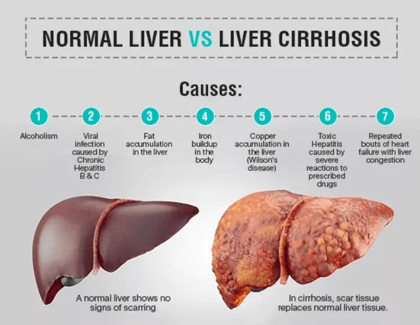Normal liver compared with a cirrhotic liver